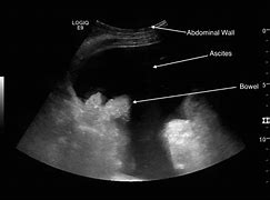 Image result for Paracentesis Puncture Site