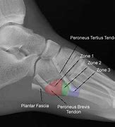 Image result for Jones Fracture Orthobullets