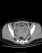 Image result for Ruptured Ovarian Cyst