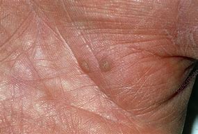 Image result for Warts On the Hands