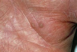 Image result for Palm Warts