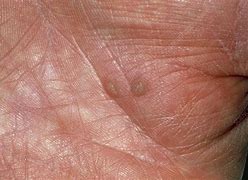 Image result for Flat Warts On Palms