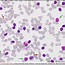 Image result for Chronic Lymphocytic Leukemia Cells