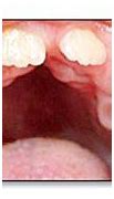 Image result for Hereditary Gingival Fibromatosis