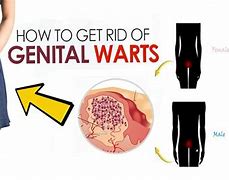 Image result for Fast Genital Wart Removal