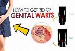 Image result for How You Get Genital Warts