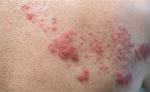 Image result for Shingles Skin Disease