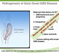 Image result for GBS Bacteriuria