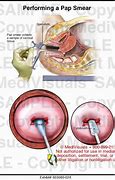 Image result for Pap Smear Procedure Drawing
