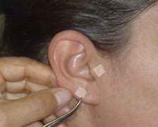 Image result for acupunturs