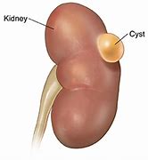 Image result for Renal Cyst Size