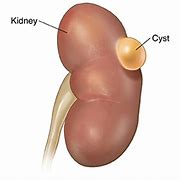 Image result for Kidney Cyst Size