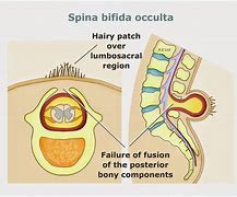 Image result for Spina Bifida Symptoms