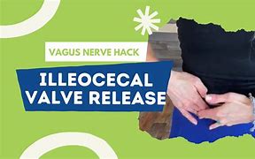 Image result for ileocecal