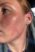 Image result for Severely Textured Skin