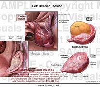 Image result for Ovarian Torsion
