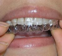Image result for Invisible Line Dental