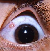 Image result for Bulbar Conjunctival Lymph Cyst