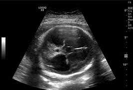 Image result for 2 Cm Dilated 39 Weeks