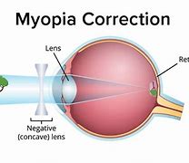 Image result for Corrective Lens for Myopia