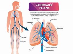 Image result for co_to_znaczy_zator_tętnicy_płucnej