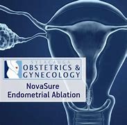 Image result for Microwave Ablation of Uterine Adenomyosis