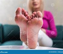 Image result for Calluses Soles