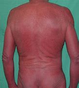 Image result for Exfoliative Dermatitis Dermnet