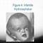 Image result for Pediatric Hydrocephalus