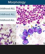 Image result for Acute Lymphoblastic Leukemia Child