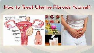 Image result for Treatment for Fibroids in Uterus
