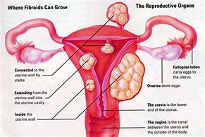 Image result for 9Mm Fibroid