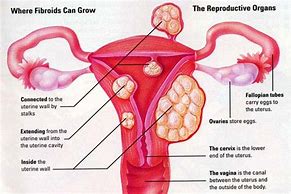 Image result for 4.5 Cm Fibroid