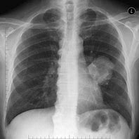 Image result for 9 Cm Lung Tumor