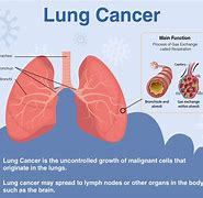 Image result for Lung Cancer Speed Run