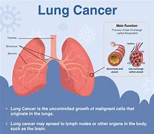 Image result for Malignant Lung Tumor