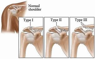 Image result for ACL Shoulder Injury