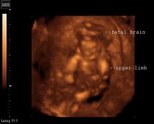 Image result for Acrania Ultrasound