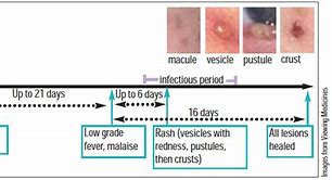 Image result for Chickenpox Mode of Transmission