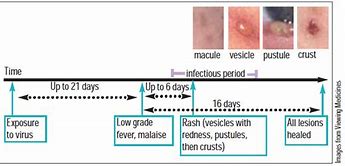 Image result for Stages of Chickenpox