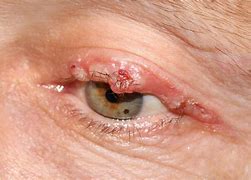 Image result for Cyst On Upper Eyelid