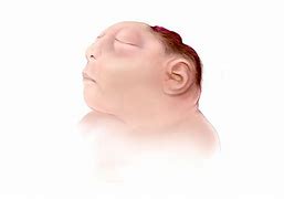 Image result for Anencephaly Case