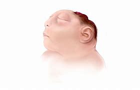 Image result for Anencephaly Cure