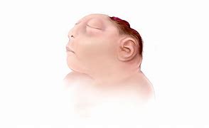 Image result for Anencephaly Side Profile