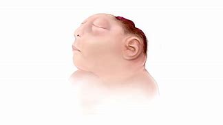Image result for Worst Case Anencephaly