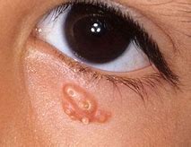 Image result for Contagious Molluscum Children Eye