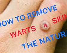 Image result for Natural Skin Tag Removal