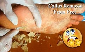Image result for Plantar Callus Removal