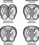 Image result for Identical Twins Ultrasound