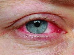 Image result for Trachomatis Eye